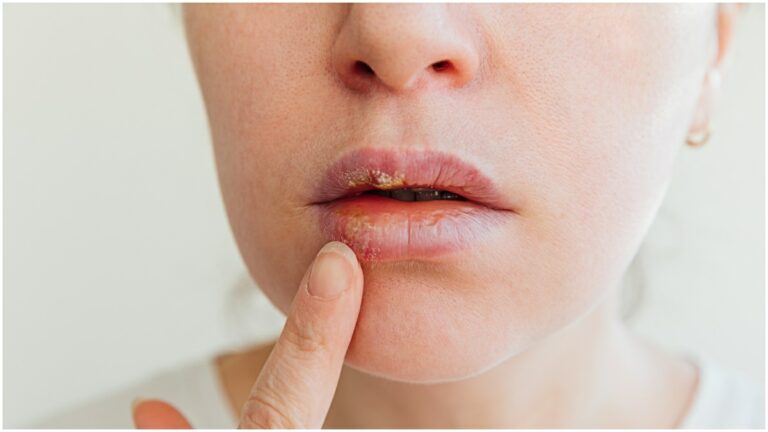كيف يمكنك التخلص من البثور التي تظهر على الشفاه؟