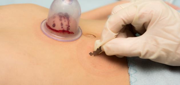 بالفيديو: قد تسبب الوفاة.. مختصة تُحذر من عمل الحجامة الخاطئة