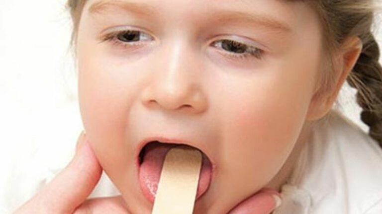 طبيب يحذر من إهمال التهاب الحلق لدى الأطفال ويكشف عن الفرق بين الفيروسي والبكتيري