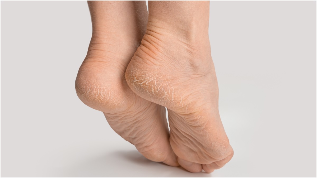 كيف تتخلصين من جفاف القدمين؟.. وهذه أهم نصيحة لنعومتها