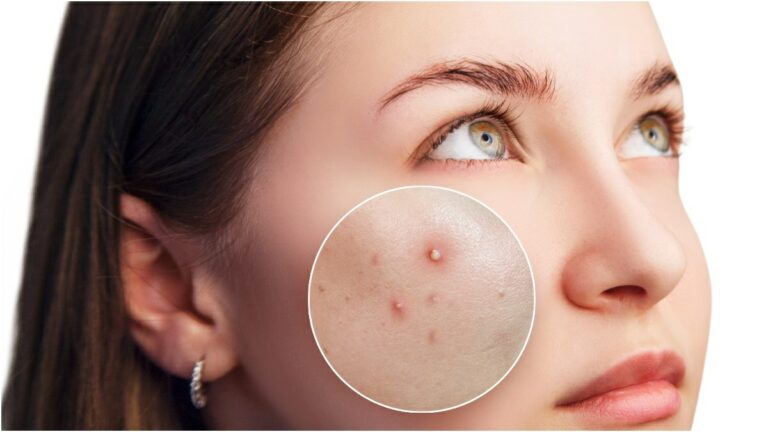 أسباب غير متوقعة لظهور البثور والحبوب على بشرتك