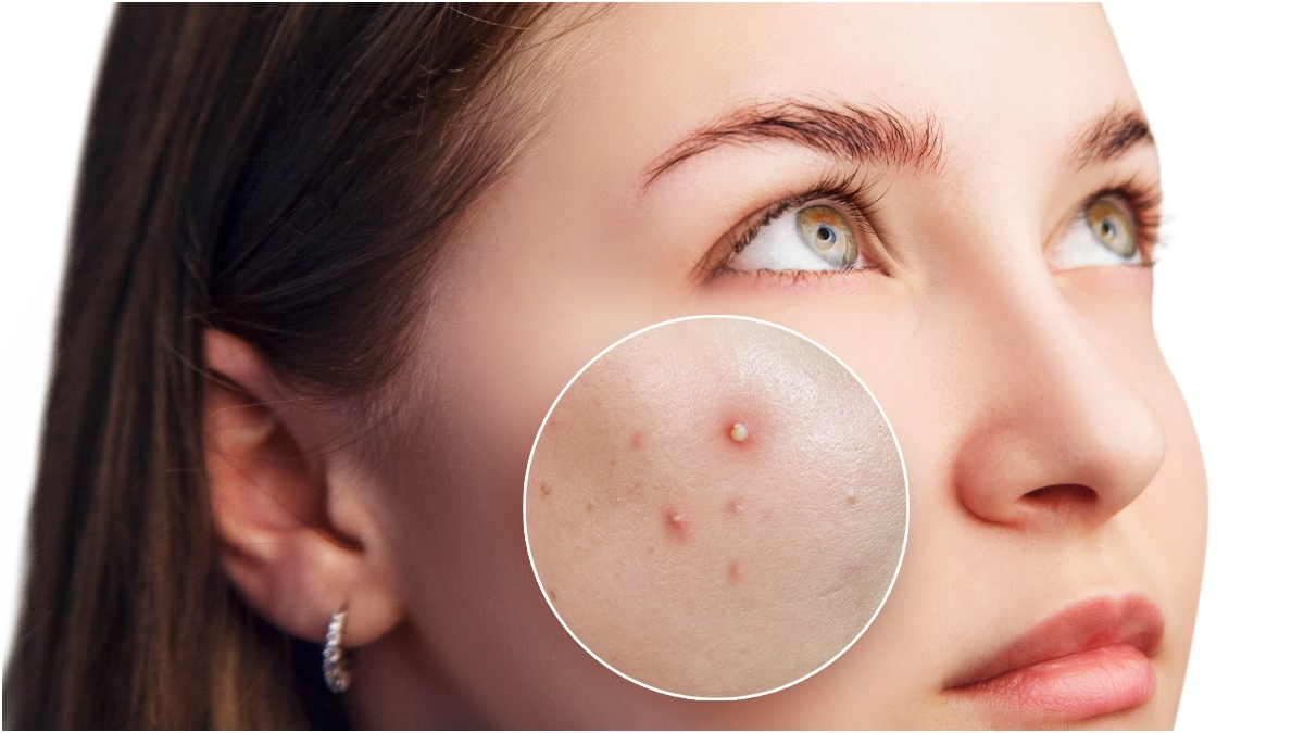 أسباب غير متوقعة لظهور البثور والحبوب على بشرتك